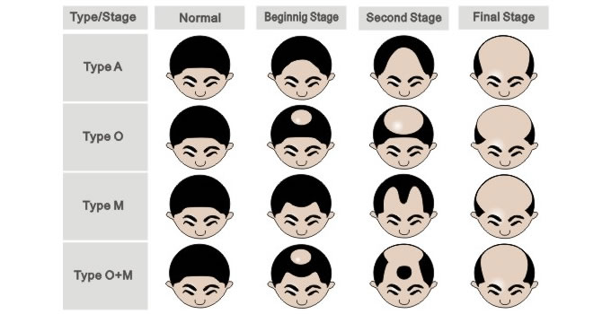 types of balding patterns