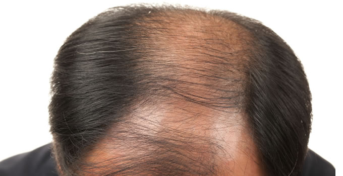 hair loss minoxidil