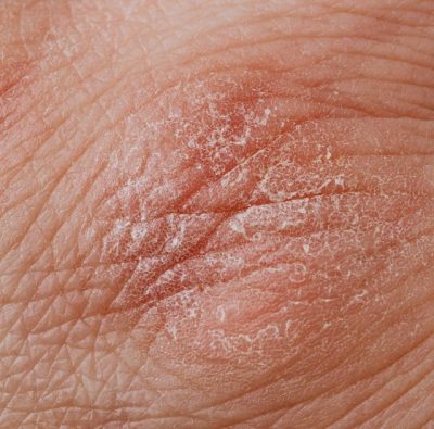 fungal infections on skin